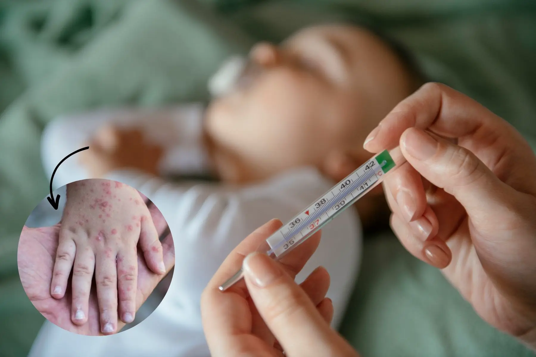 Trẻ mắc bệnh tay chân miệng có thể bị sốt cao